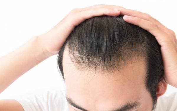 VTG Smart Hair giúp xóa tan nỗi lo rụng tóc 2 bên thái dương