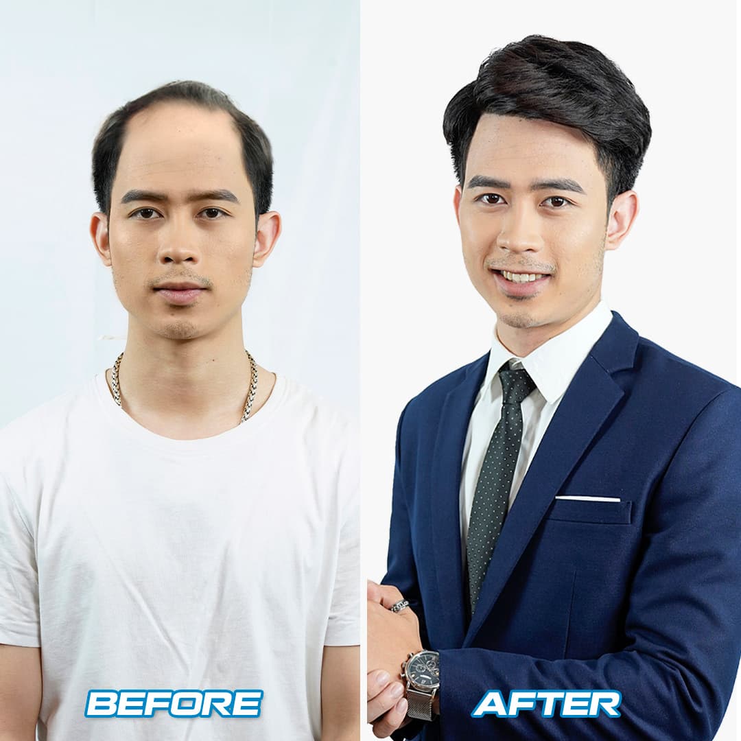 Mua Tóc Giả Mái Hói Cho Nam và những điều bạn nên biết