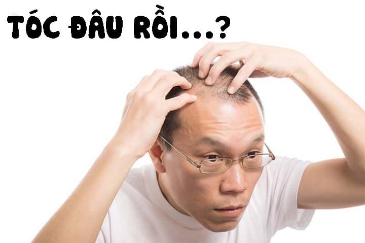 Hói đầu sớm ở nam giới có phải là bệnh?