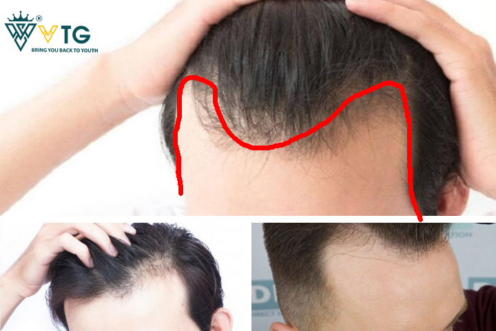 3 kiểu tóc dành cho người hói chữ M đẹp và đơn giản nhất