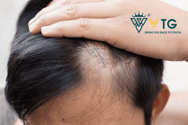 Dầu gội trị rụng tóc nam và cách lựa chọn