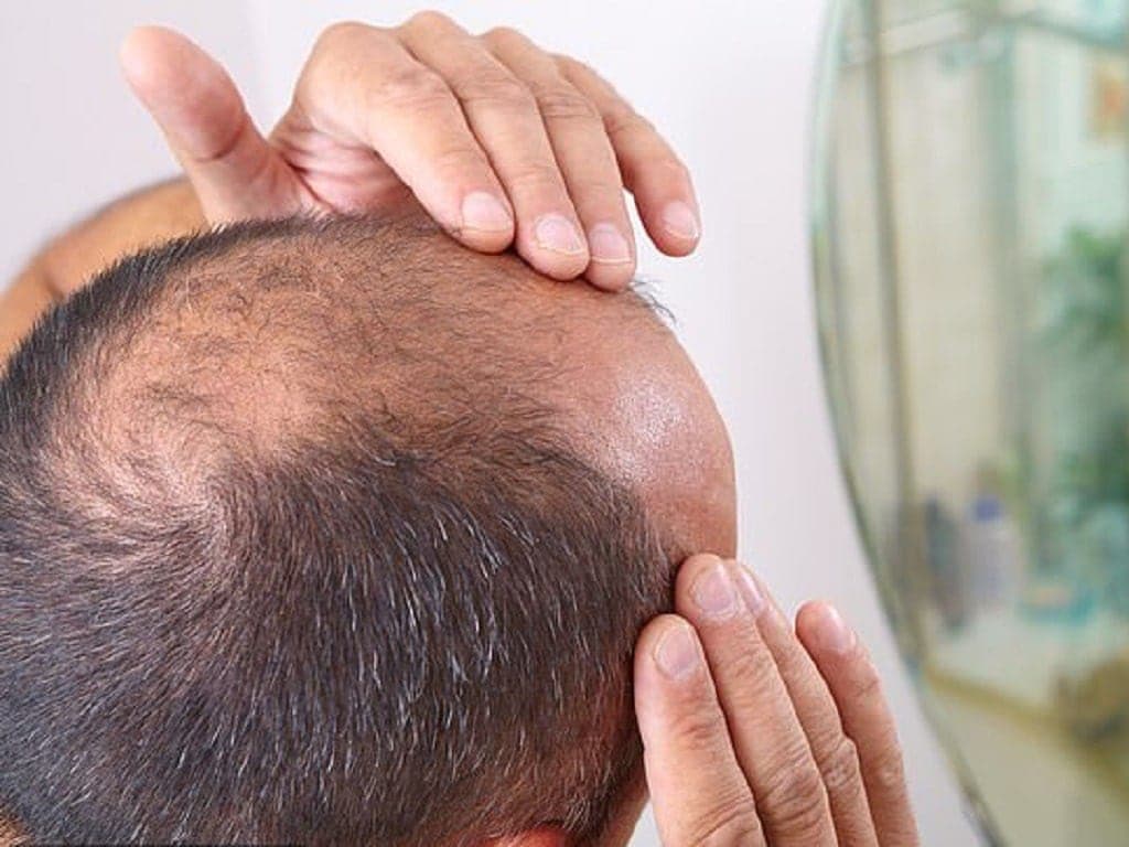 5 điều bạn cần biết về hói đỉnh đầu nam giới