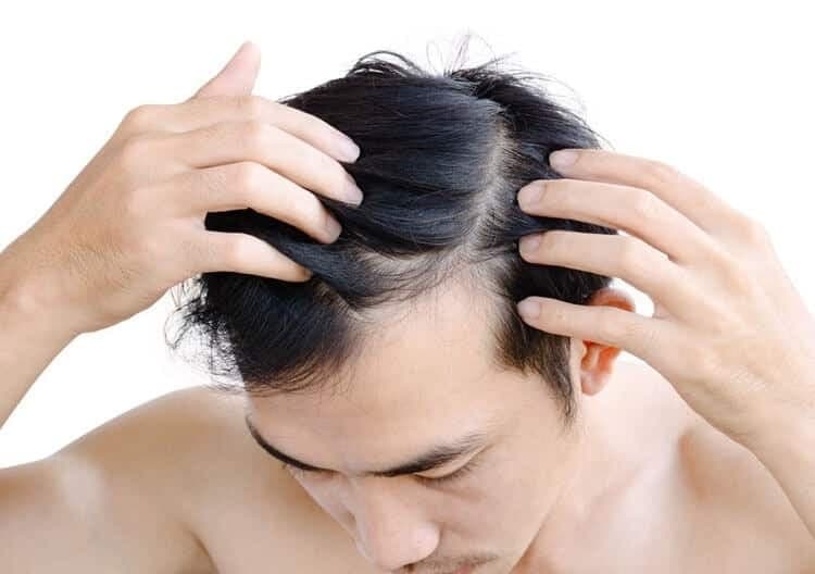 Tóc thẩm mỹ VTG  &#8211; Giải pháp cho người hói đầu