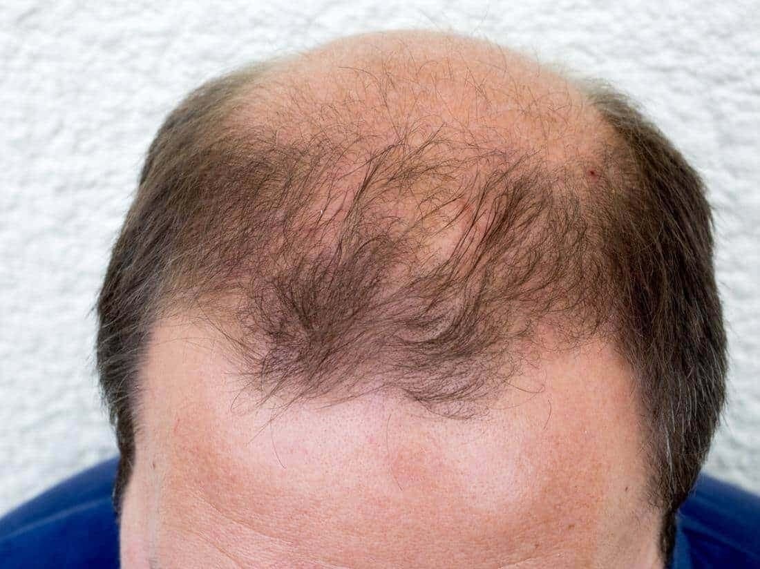 Bật mí 2 loại thuốc trị hói đầu dành cho nam