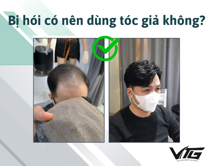 Có Nên Sử Dụng Tóc Giả Nam Cho Người Bị Hói Không?