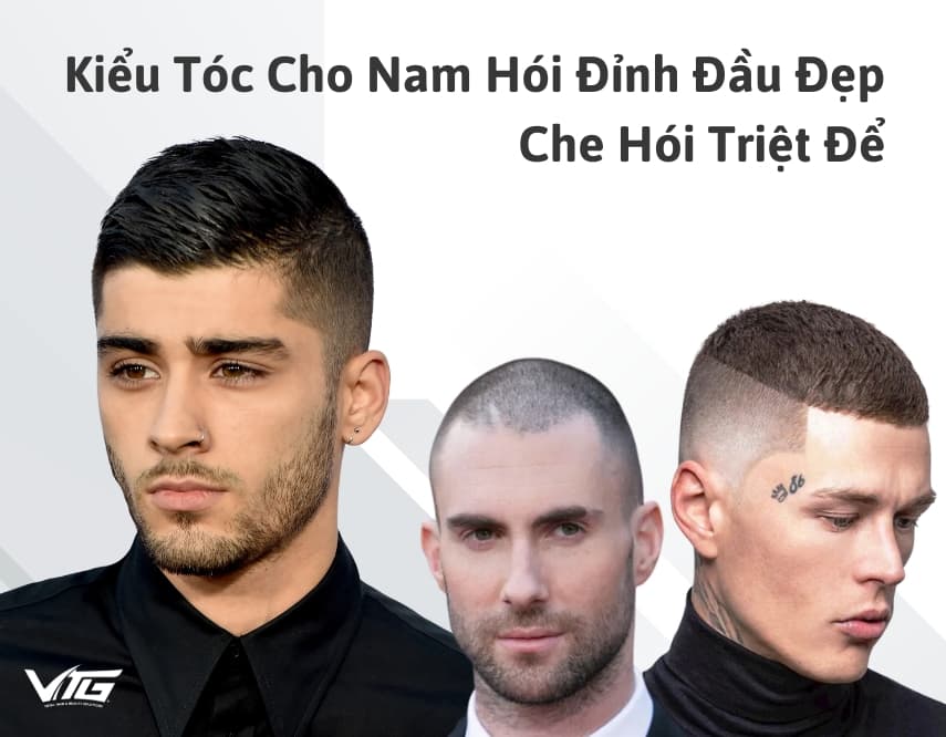 TOP 15 Kiểu Tóc Cho Nam Hói Đỉnh Đầu Đẹp, Che Hói Triệt Để