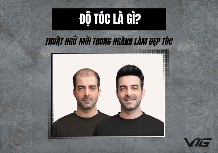 Độ Tóc Là Gì? Xu Hướng Giúp Nam Giới Lấy Lại Mái Tóc Dày Đẹp Tự Nhiên