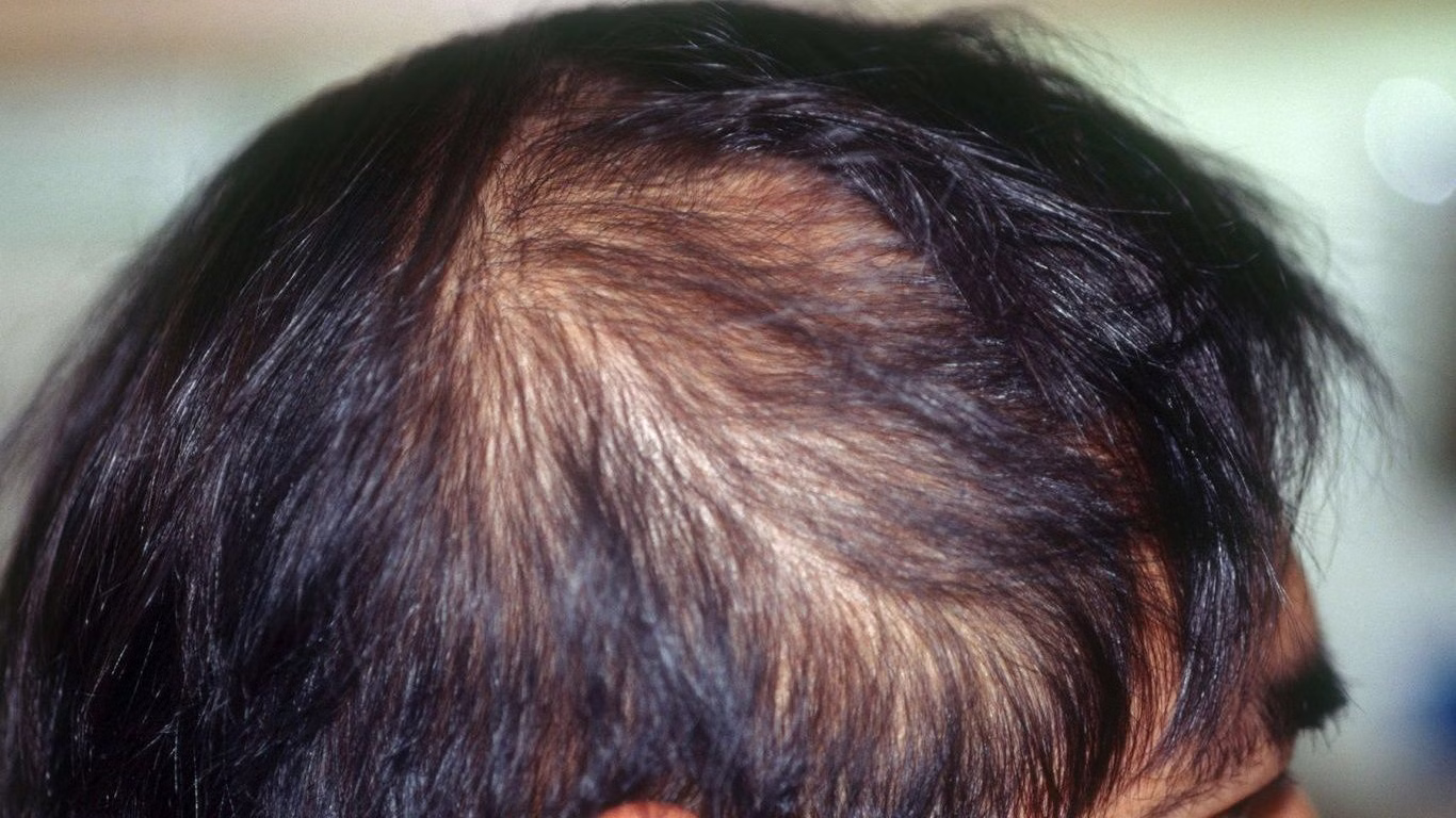 Mất Chân Tóc Có Mọc Lại Không? Trường Hợp Nào Có Thể Mọc Lại?