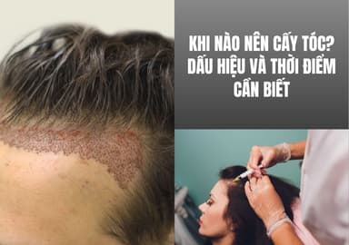 Khi Nào Nên Cấy Tóc? Dấu Hiệu Và Thời Điểm Cần Biết