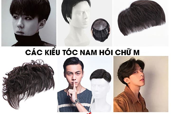 Bạn có thể cải thiện hói chữ M trong 5 phút với tóc thẩm mỹ