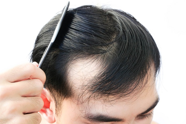Rụng tóc hình vành khăn nguyên nhân và cách khắc phục