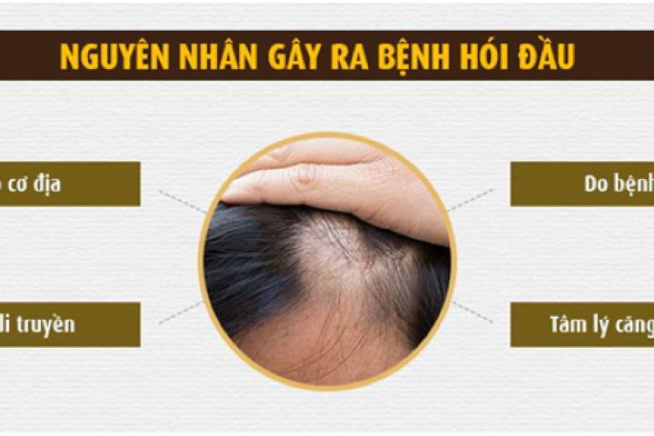 Cuối cùng thì hói đầu di truyền đã có giải pháp khắc phục