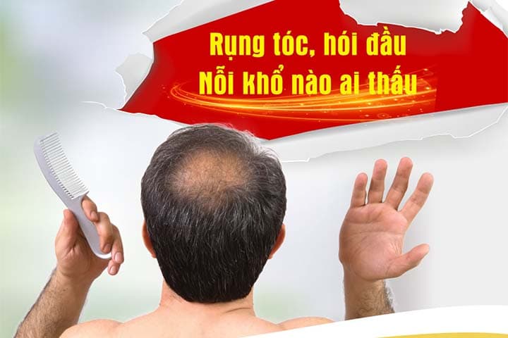 Rụng tóc nam tuổi 30 và những điều bạn cần biết