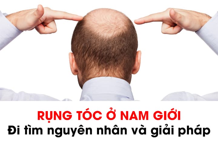 Rụng tóc từng mảng chưa bao giờ là nỗi lo
