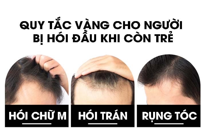 Tiết lộ nguyên nhân hói đầu mà 99% đàn ông gặp phải
