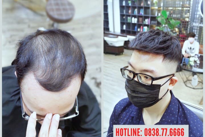 Sự thật về cách điều trị hói đầu ở nam giới còn trẻ