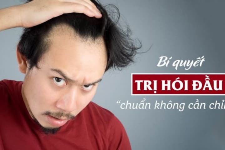 Khám phá giải pháp trị hói đầu khi còn trẻ ở nam giới