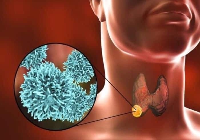 Xạ trị iod 131 có bị rụng tóc không? Tìm hiểu về xạ trị