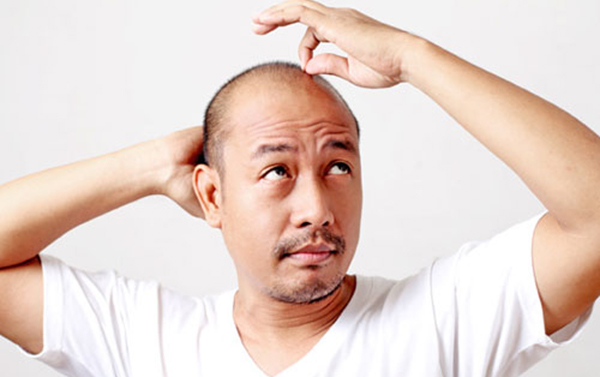 Nguyên nhân gây rụng tóc ở nam giới và cách phòng tránh