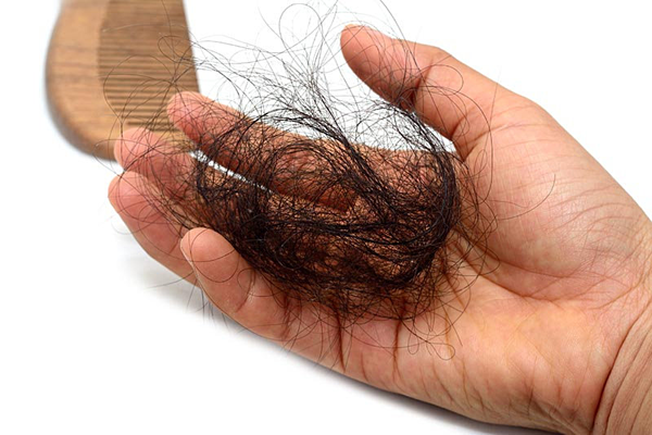 Rụng tóc di truyền có chữa được không?