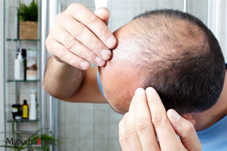 Làm thế nào để giảm rụng tóc ở nam giới?