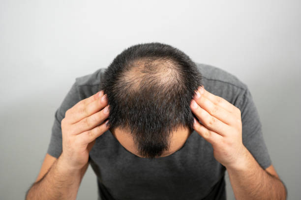 Tổng hợp 7 Nguyên nhân gây rụng tóc ở nam giới