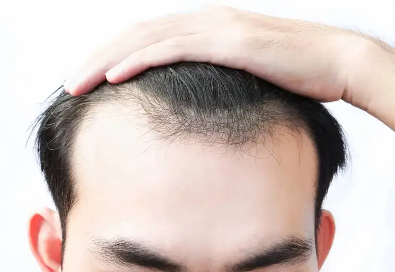 Bị rụng tóc nhiều ở nam là bệnh gì?