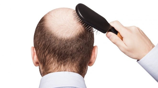 Nguyên nhân gây ra rụng tóc đỉnh đầu nam là gì?