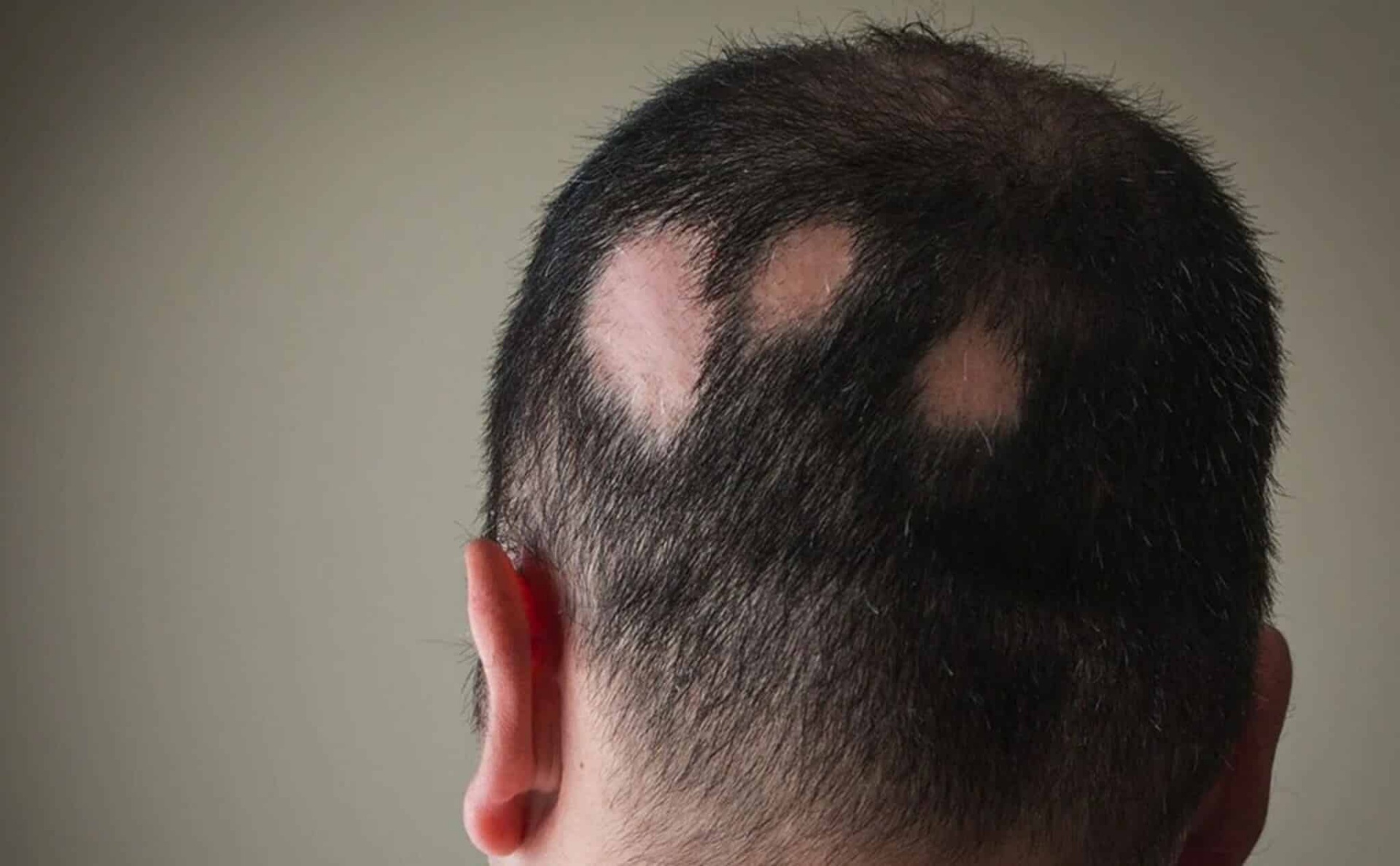 Rụng tóc hình đồng xu ở nam giới có nguy hiểm không?