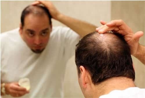 5 nguyên nhân gây rụng tóc không sẹo ở nam giới