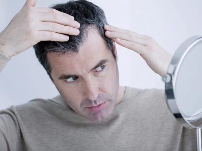 Rụng tóc từng mảng Nguyên nhân triệu chứng  cách chữa trị  Rungtocvn